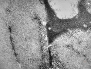 F,45y. | jejunum … amyloidosis F,45y. | jejunum … amyloidosis